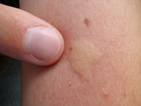 Mosquito-Bite-Reaction